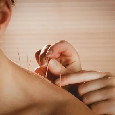 Close-up hands place acupuncture needles in shoulder; example of dry needling therapy technique for pain