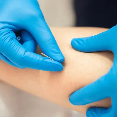 Clinician wearing blue gloves inserts fine needle into forearm during therapeutic trigger point procedure today